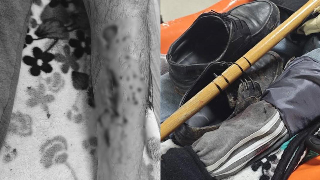 Başıboş köpeğin saldırısına uğrayan yaşlı adamın bacağına 25 dikiş atıldı