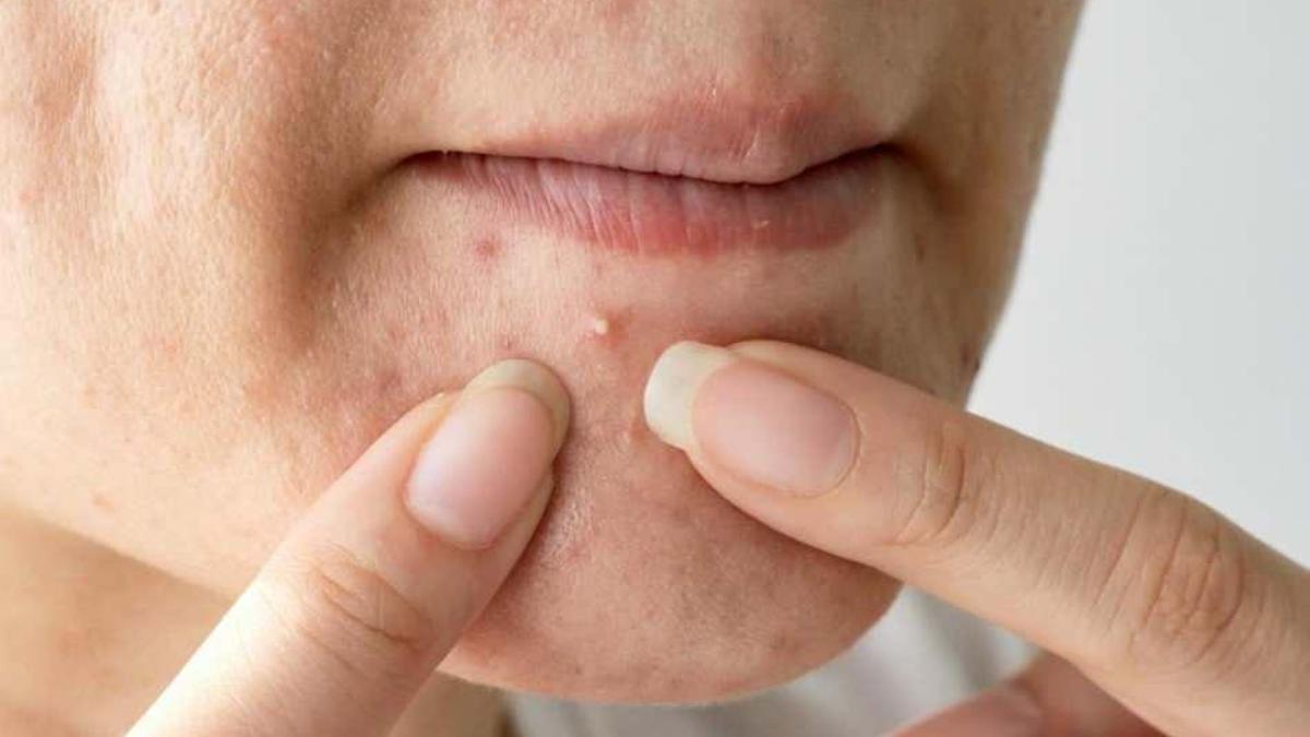 Sivilce Patlatmak Abdesti Bozar Mı? Sivilce Sıkınca Abdest Bozulur Mu?